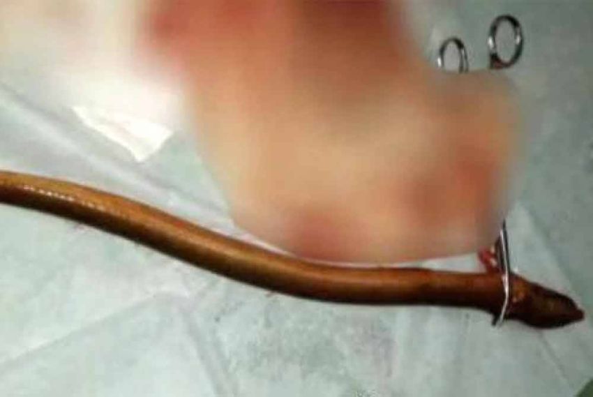 Dokter Berhasil Keluarkan Belut Hidup dari dalam Perut Pria Ini